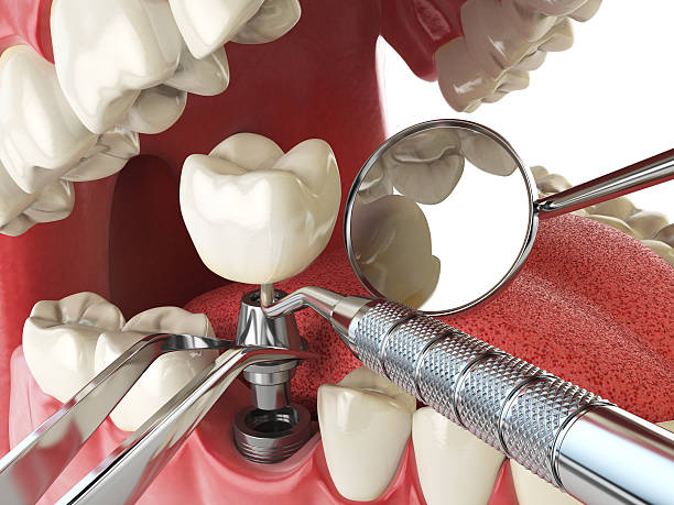 Best Dental Abscess Treatment in Eagle Lake, TX